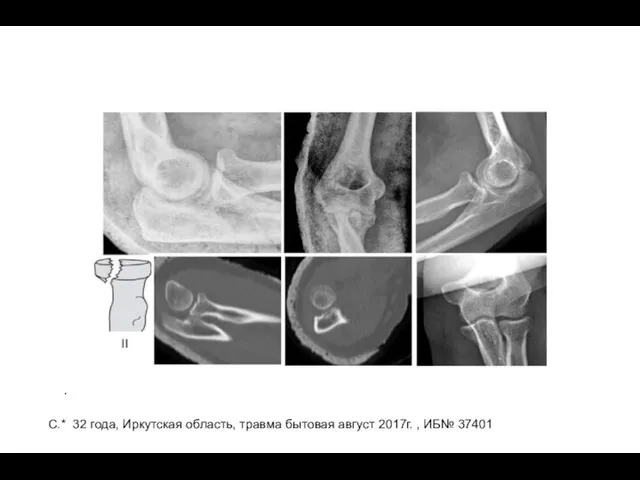 . C.* 32 года, Иркутская область, травма бытовая август 2017г. , ИБ№ 37401