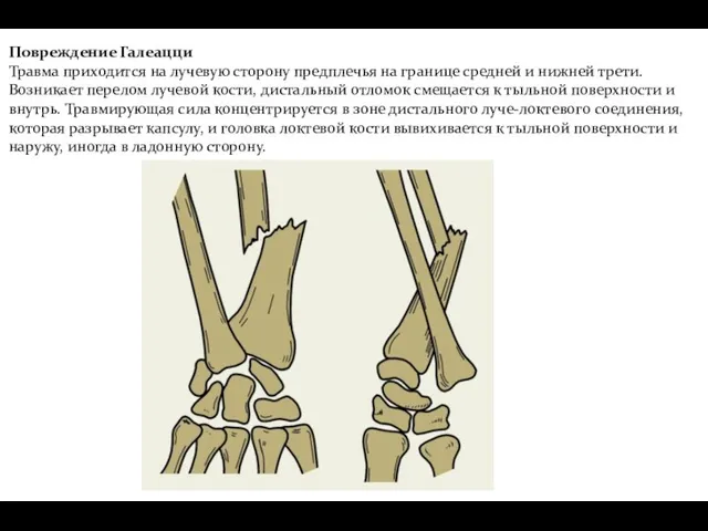 Повреждение Галеацци Травма приходится на лучевую сторону предплечья на границе
