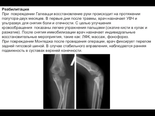 Реабилитация При повреждении Галеацци восстановление руки происходит на протяжении полутора-двух месяцев. В первые