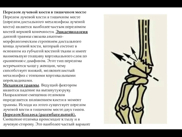 Перелом лучевой кости в типичном месте Перелом лучевой кости в типичном месте (перелом