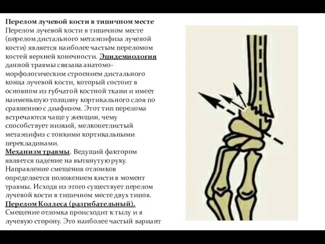 Перелом лучевой кости в типичном месте Перелом лучевой кости в