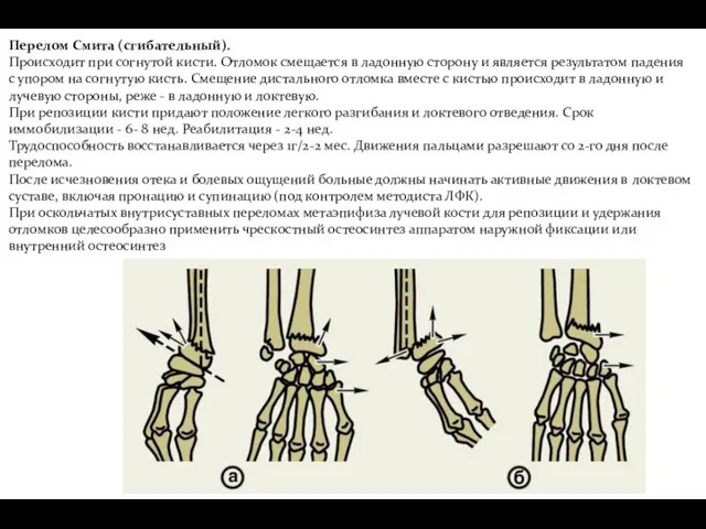 Перелом Смита (сгибательный). Происходит при согнутой кисти. Отломок смещается в