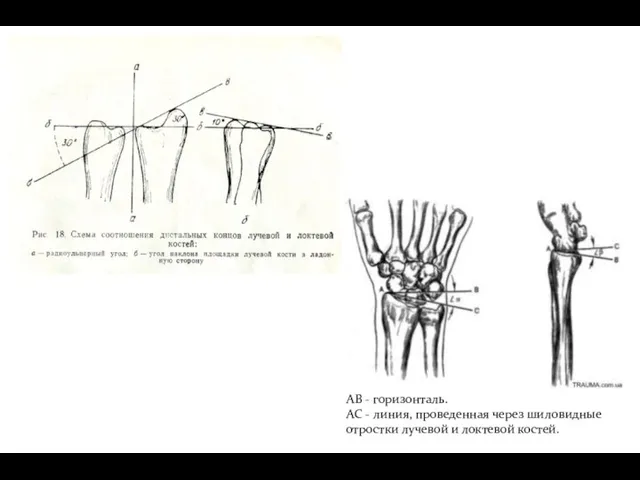 AB - горизонталь. AC - линия, проведенная через шиловидные отростки лучевой и локтевой костей.