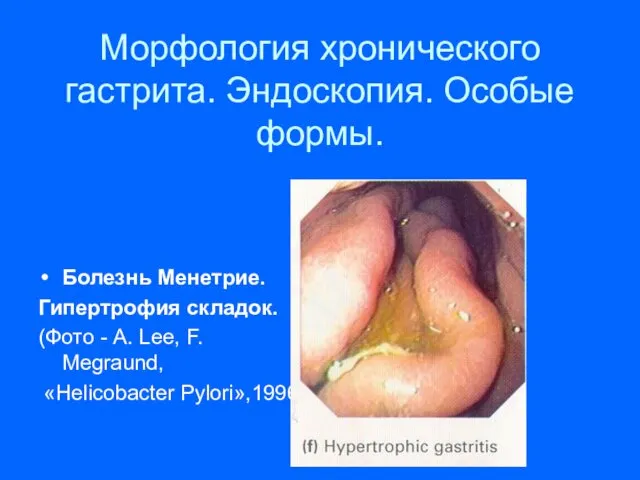Морфология хронического гастрита. Эндоскопия. Особые формы. Болезнь Менетрие. Гипертрофия складок.