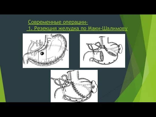 Современные операции- 1. Резекция желудка по Маки-Шалимову