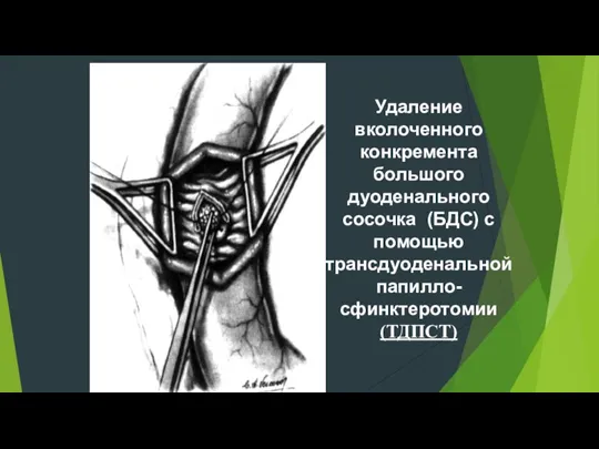 Удаление вколоченного конкремента большого дуоденального сосочка (БДС) с помощью трансдуоденальной папилло-сфинктеротомии (ТДПСТ)