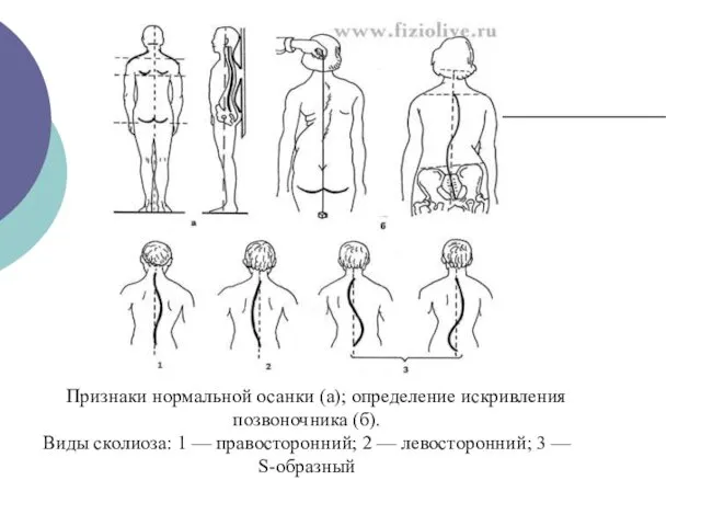 Признаки нормальной осанки (а); определение искривления позвоночника (б). Виды сколиоза: