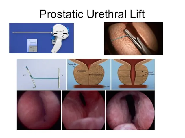 Prostatic Urethral Lift