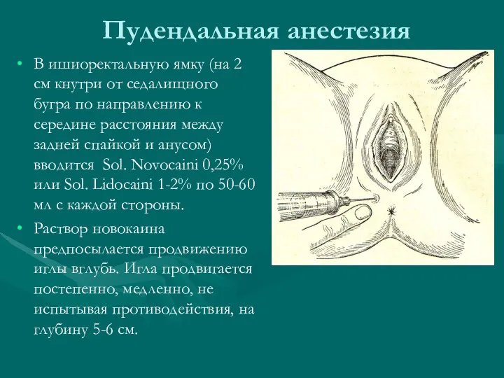 Пудендальная анестезия В ишиоректальную ямку (на 2 см кнутри от седалищного бугра по