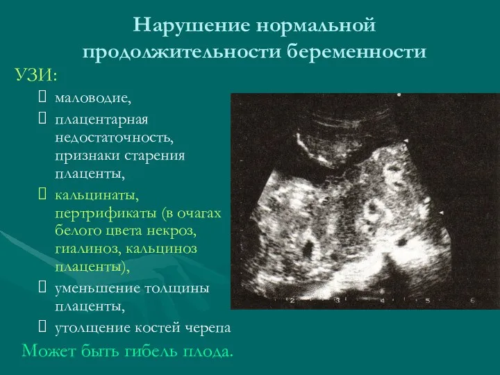 Нарушение нормальной продолжительности беременности УЗИ: маловодие, плацентарная недостаточность, признаки старения плаценты, кальцинаты, пертрификаты