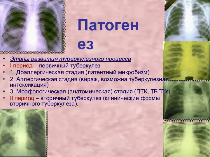 Патогенез Этапы развития туберкулезного процесса I период – первичный туберкулез