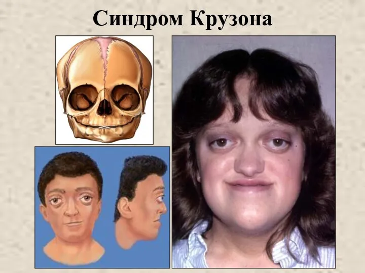 Синдром Крузона