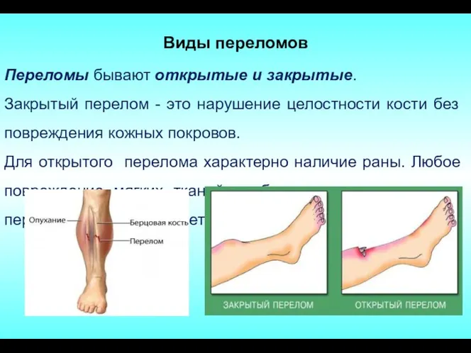 Виды переломов Переломы бывают открытые и закрытые. Закрытый перелом -