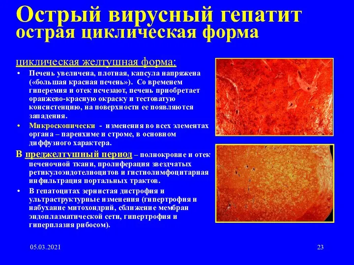 05.03.2021 Острый вирусный гепатит острая циклическая форма циклическая желтушная форма: