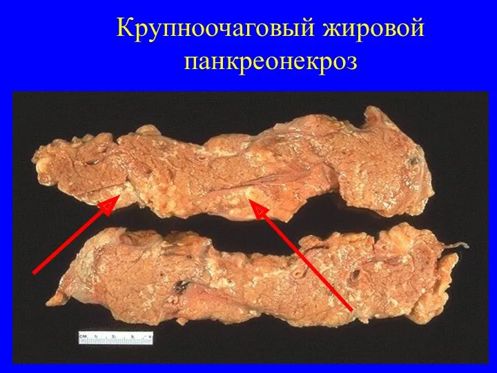 05.03.2021 Крупноочаговый жировой панкреонекроз