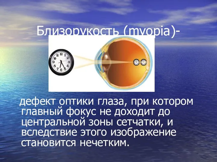 Близорукость (myopia)- дефект оптики глаза, при котором главный фокус не