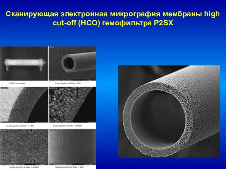 Сканирующая электронная микрография мембраны high cut-off (HCO) гемофильтра P2SX