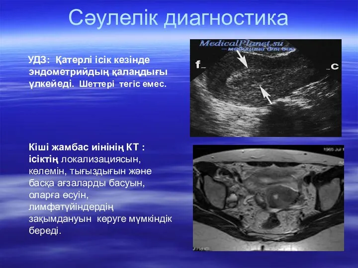 Сәулелік диагностика УДЗ: Қатерлі ісік кезінде эндометрийдың қалаңдығы үлкейеді. Шеттері