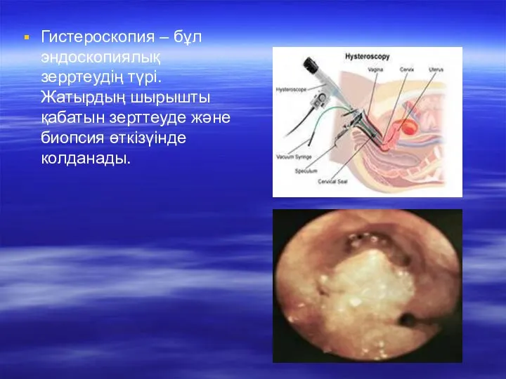 Гистероскопия – бұл эндоскопиялық зерртеудің түрі. Жатырдың шырышты қабатын зерттеуде және биопсия өткізүінде колданады.