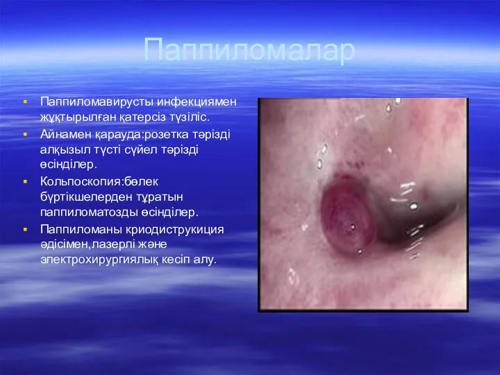 Паппиломалар Паппиломавирусты инфекциямен жұқтырылған қатерсіз түзіліс. Айнамен қарауда:розетка тәрізді алқызыл