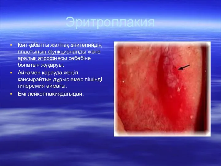 Эритроплакия Көп қабатты жалпақ эпителийдің пластының функционалды және аралық атрофиясы