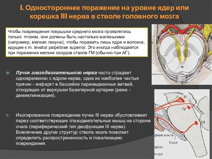 Пучок глазодвигательного нерва часто страдает одновременно с ядром нерва, одна