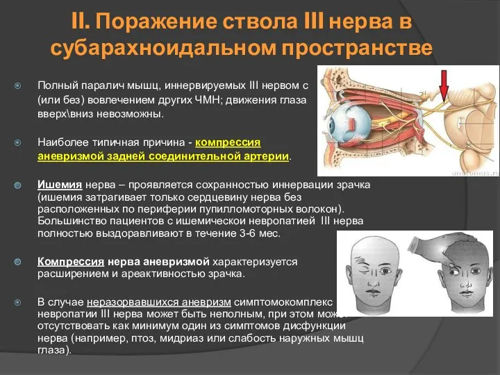 II. Поражение ствола III нерва в субарахноидальном пространстве Полный паралич