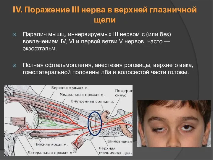 IV. Поражение III нерва в верхней глазничной щели Паралич мышц, иннервируемых III нервом