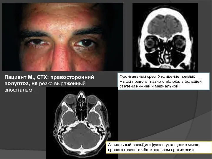 Фронтальный срез. Утолщение прямых мышц правого глазного яблока, в большей степени нижней и