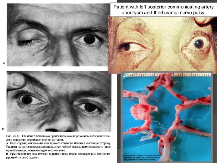 Patient with left posterior communicating artery aneurysm and third cranial nerve palsy.