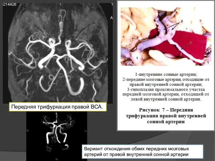 Передняя трифуркация правой ВСА. Вариант отхождения обеих передних мозговых артерий от правой внутренней сонной артерии