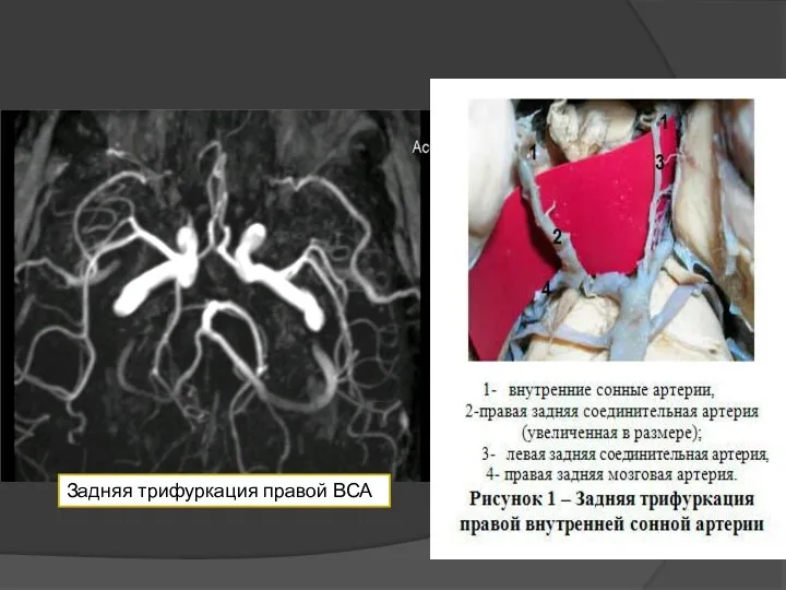 Задняя трифуркация правой ВСА