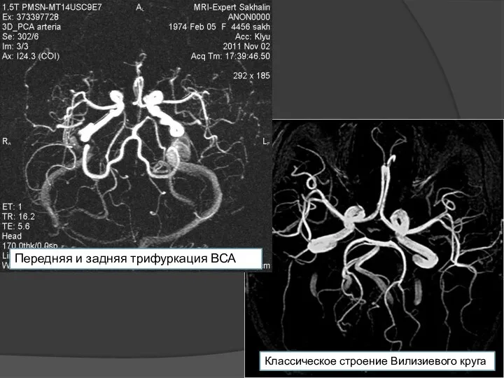 Классическое строение Вилизиевого круга Передняя и задняя трифуркация ВСА