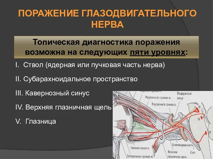 ПОРАЖЕНИЕ ГЛАЗОДВИГАТЕЛЬНОГО НЕРВА I. Ствол (ядерная или пучковая часть нерва) II. Субарахноидальное пространство