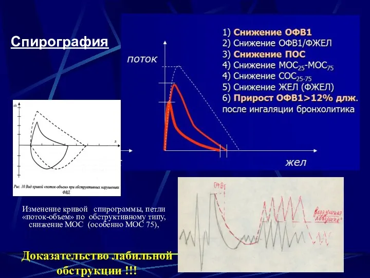 Спирография Изменение кривой спирограммы, петли «поток-объем» по обструктивному типу, снижение МОС (особенно МОС