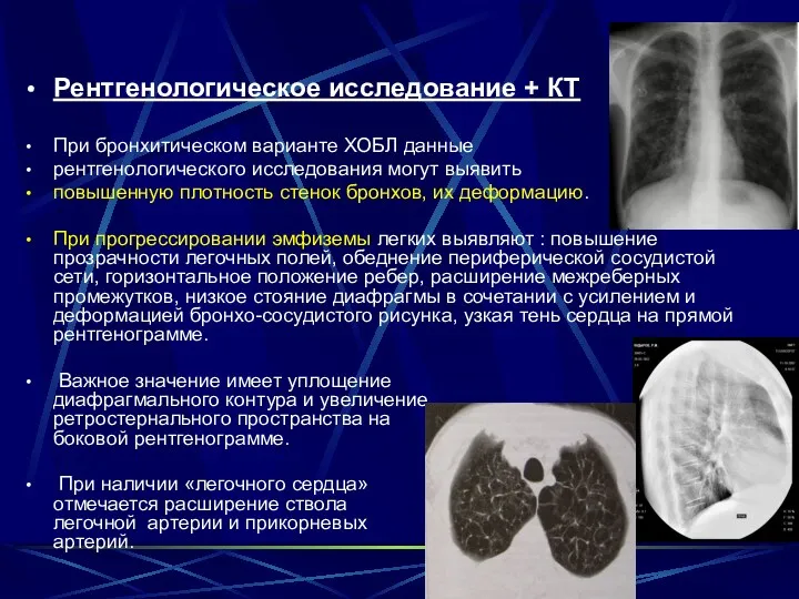 Рентгенологическое исследование + КТ При бронхитическом варианте ХОБЛ данные рентгенологического исследования могут выявить