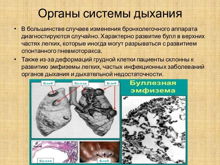 Органы системы дыхания В большинстве случаев изменения бронхолегочного аппарата диагностируются