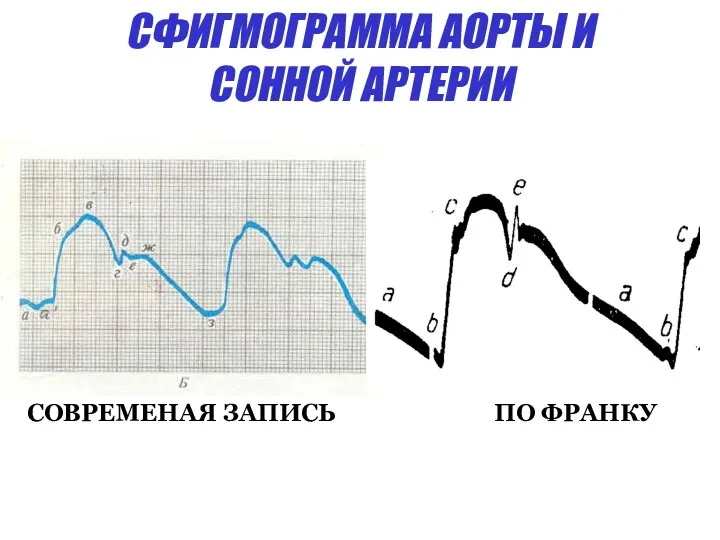 СФИГМОГРАММА АОРТЫ И СОННОЙ АРТЕРИИ СОВРЕМЕНАЯ ЗАПИСЬ ПО ФРАНКУ