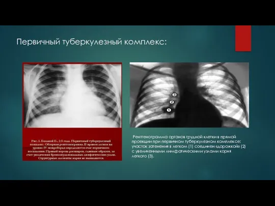 Первичный туберкулезный комплекс: Рентгенограмма органов грудной клетки в прямой проекции при первичном туберкулезном