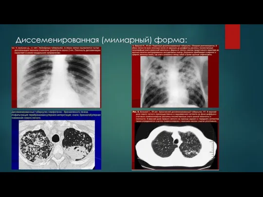 Диссеменированная (милиарный) форма: