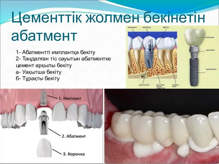 Цементтік жолмен бекінетін абатмент 1- Абатментті имплантқа бекіту 2- Таңдалған