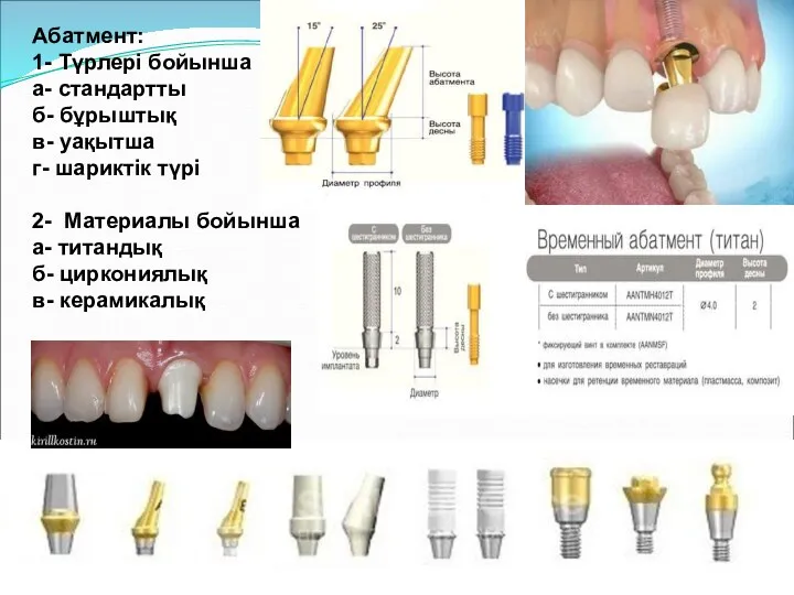 Абатмент: 1- Түрлері бойынша а- стандартты б- бұрыштық в- уақытша