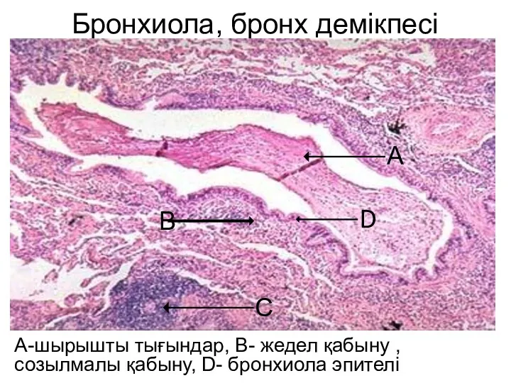 Бронхиола, бронх демікпесі А-шырышты тығындар, В- жедел қабыну , созылмалы