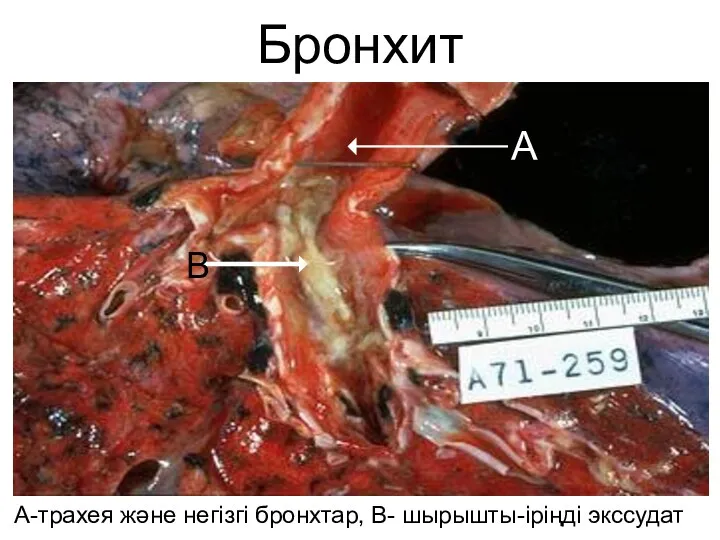 Бронхит А-трахея және негізгі бронхтар, В- шырышты-іріңді экссудат А В