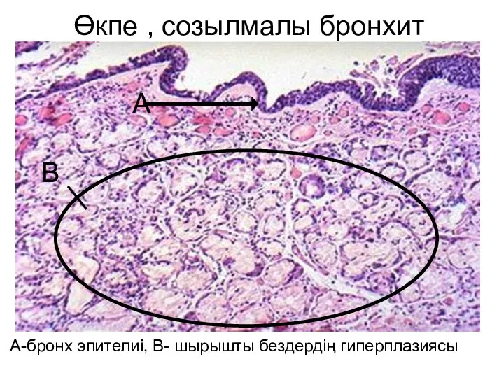 Өкпе , созылмалы бронхит А-бронх эпителиі, В- шырышты бездердің гиперплазиясы А В