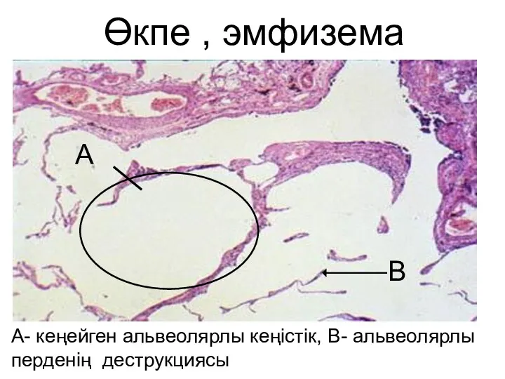 Өкпе , эмфизема А- кеңейген альвеолярлы кеңістік, В- альвеолярлы перденің деструкциясы А В