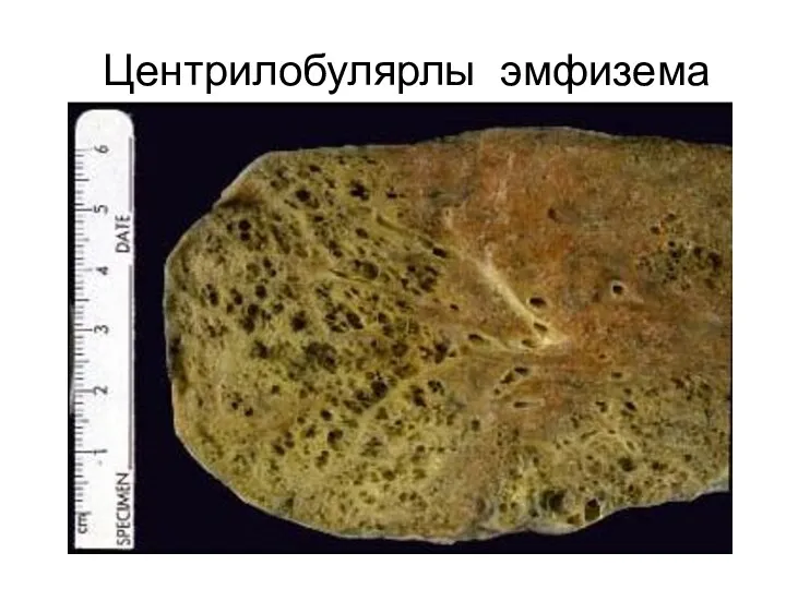 Центрилобулярлы эмфизема