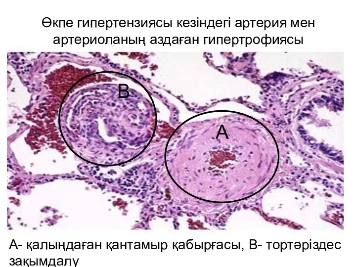 Өкпе гипертензиясы кезіндегі артерия мен артериоланың аздаған гипертрофиясы А- қалыңдаған