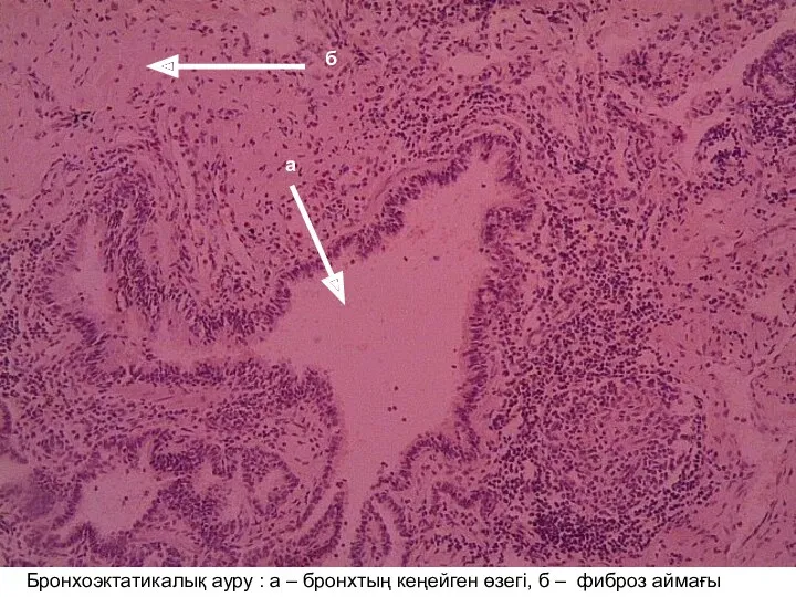 Бронхоэктатикалық ауру : а – бронхтың кеңейген өзегі, б – фиброз аймағы а б