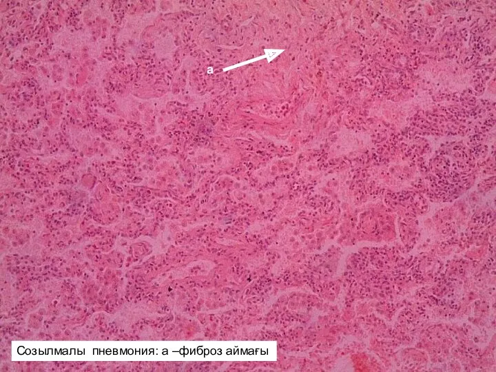 а Созылмалы пневмония: а –фиброз аймағы